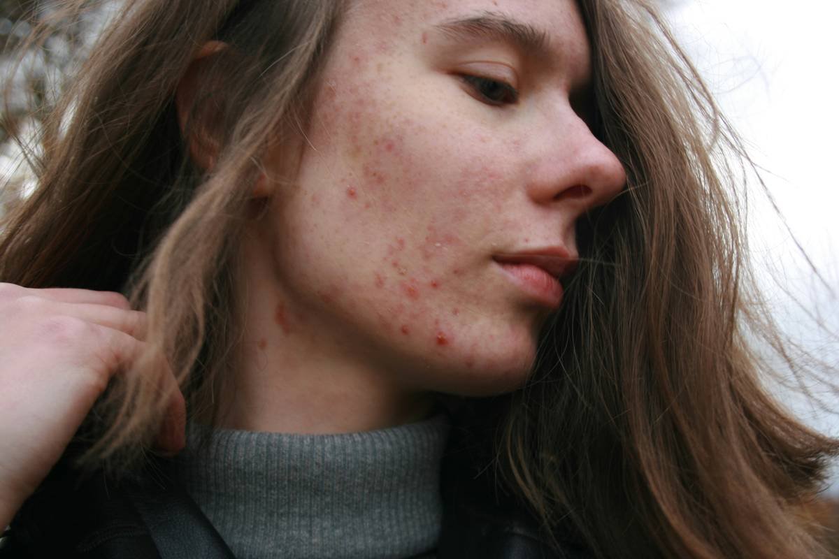 The Ultimate Guide to Choosing the Best Toner for Acne Prone Skin (Without Wasting Another Drop)